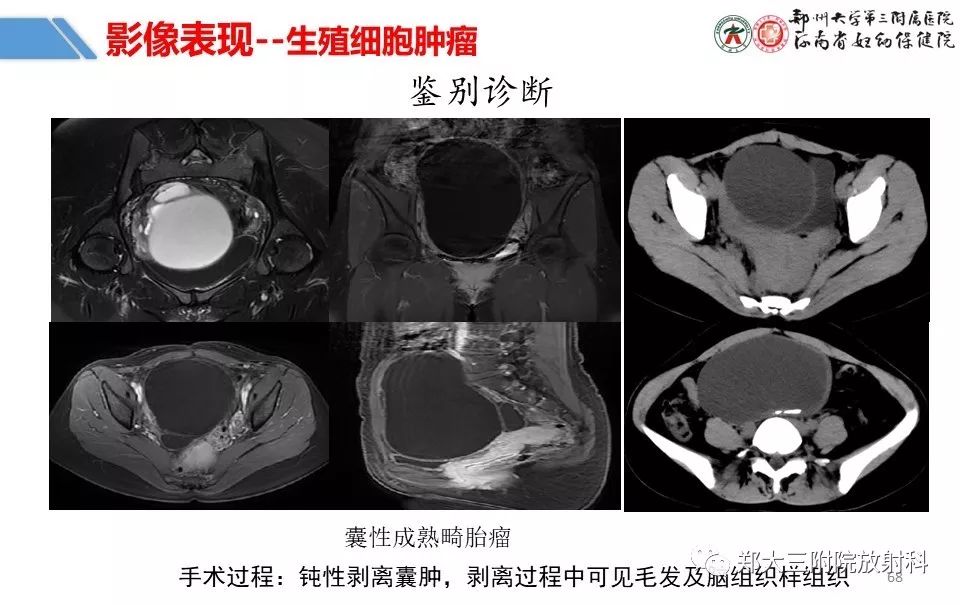 【PPT】卵巢肿瘤的影像诊断思路 【PPT】卵巢肿瘤的影像诊断思路