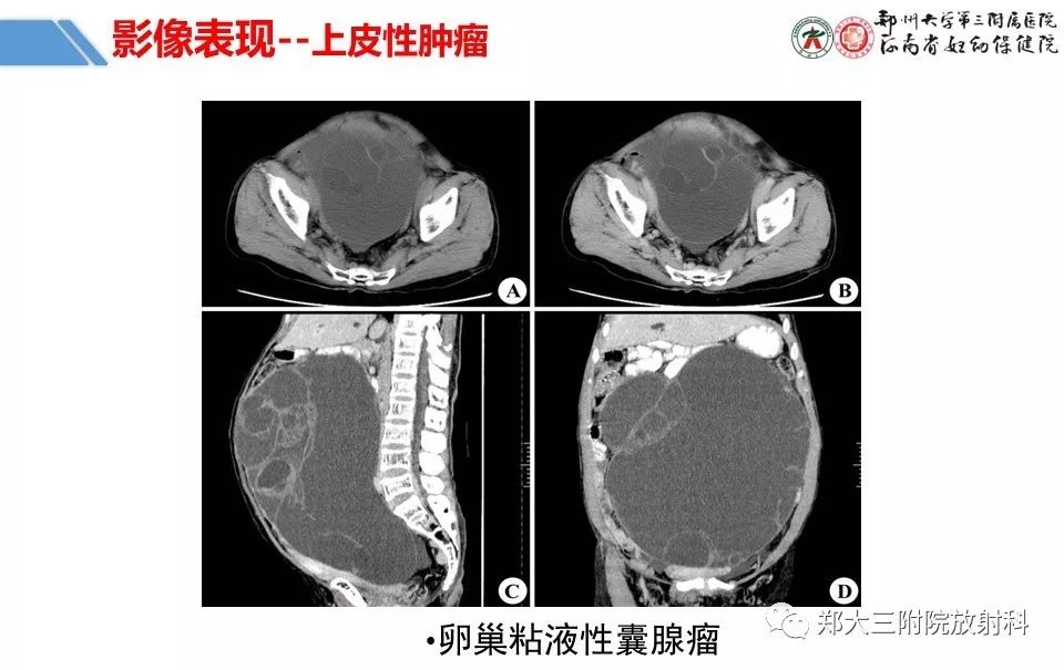 【PPT】卵巢肿瘤的影像诊断思路 【PPT】卵巢肿瘤的影像诊断思路