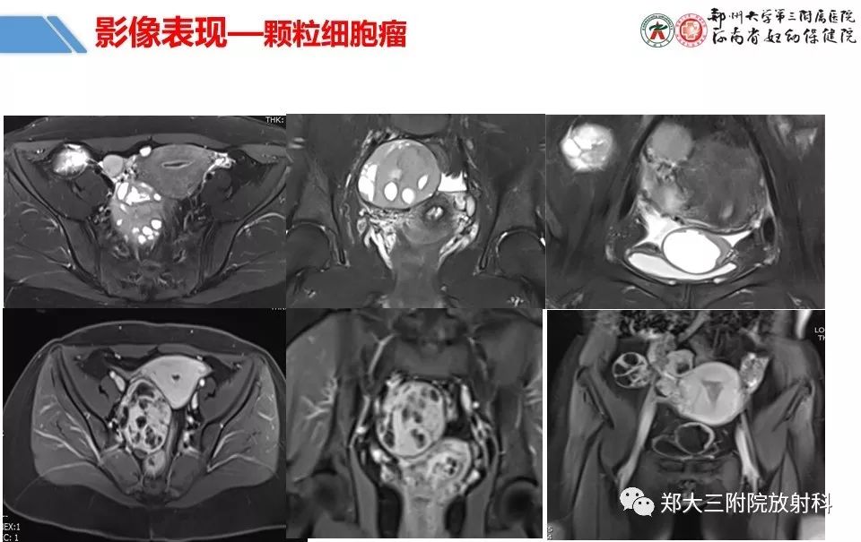 【PPT】卵巢肿瘤的影像诊断思路 【PPT】卵巢肿瘤的影像诊断思路