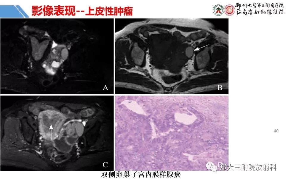 【PPT】卵巢肿瘤的影像诊断思路 【PPT】卵巢肿瘤的影像诊断思路