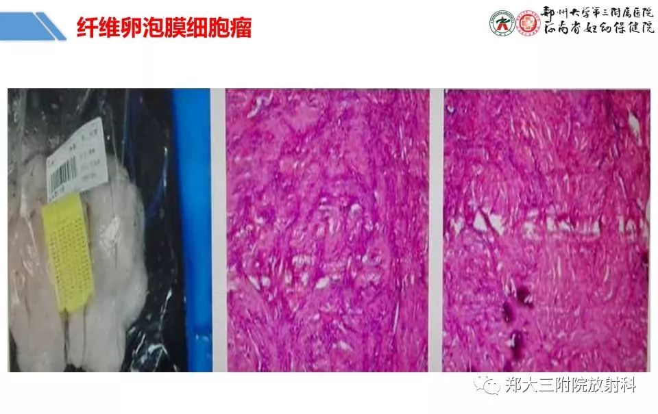 【PPT】卵巢肿瘤的影像诊断思路 【PPT】卵巢肿瘤的影像诊断思路