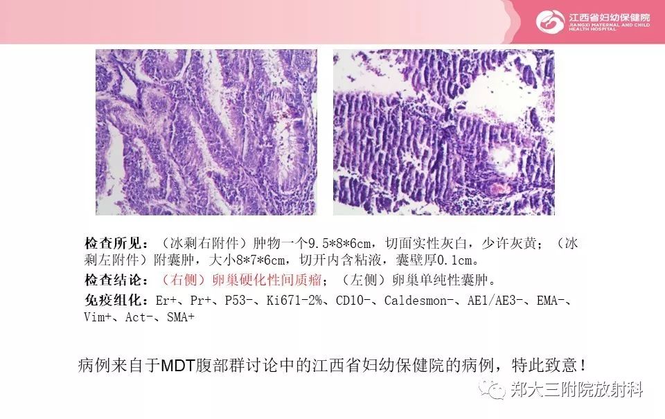 【PPT】卵巢肿瘤的影像诊断思路 【PPT】卵巢肿瘤的影像诊断思路