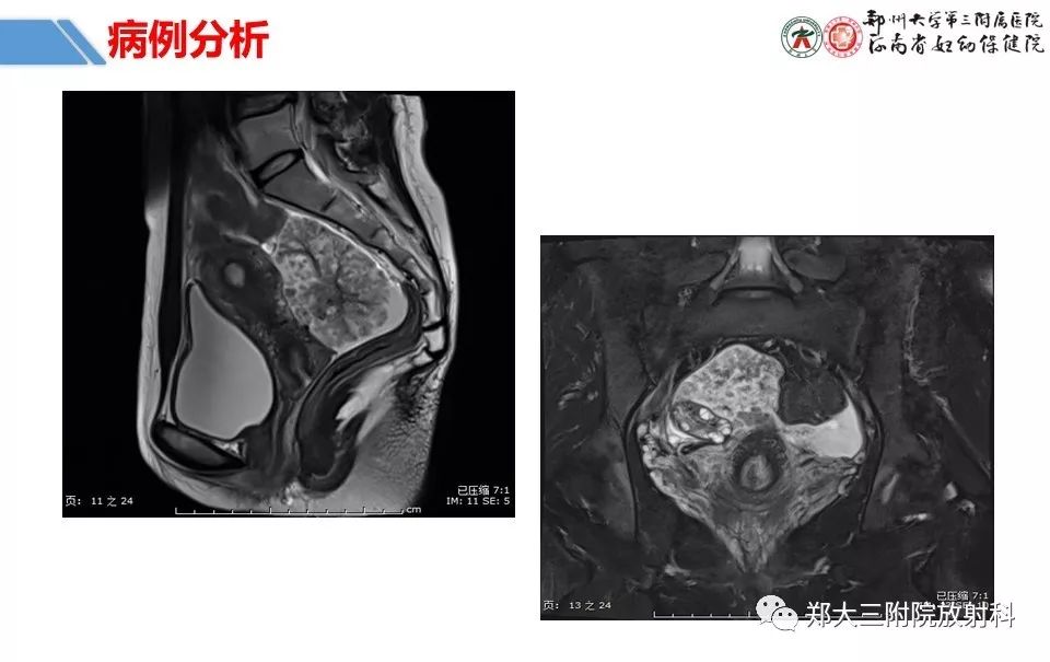 【PPT】卵巢肿瘤的影像诊断思路 【PPT】卵巢肿瘤的影像诊断思路