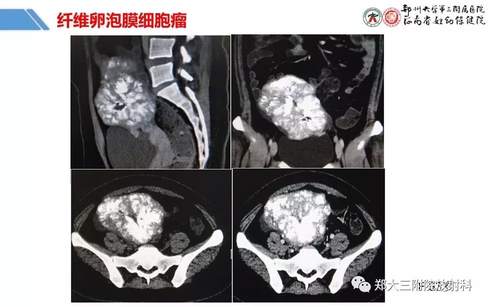 【PPT】卵巢肿瘤的影像诊断思路 【PPT】卵巢肿瘤的影像诊断思路