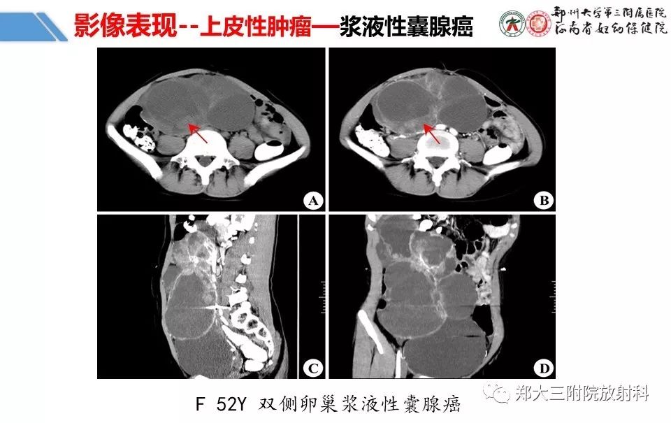 【PPT】卵巢肿瘤的影像诊断思路 【PPT】卵巢肿瘤的影像诊断思路