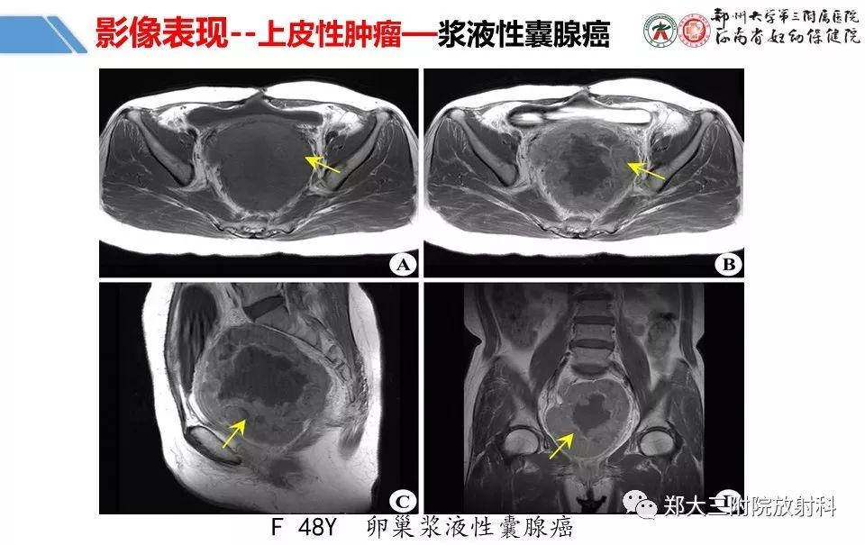 【PPT】卵巢肿瘤的影像诊断思路 【PPT】卵巢肿瘤的影像诊断思路