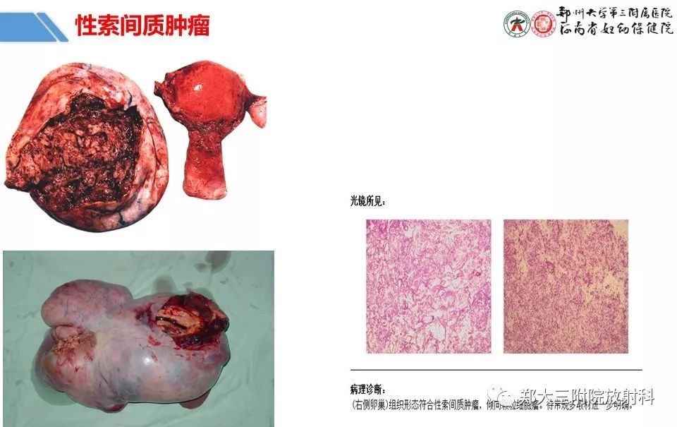 【PPT】卵巢肿瘤的影像诊断思路 【PPT】卵巢肿瘤的影像诊断思路