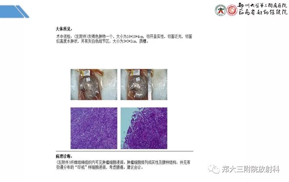 【PPT】卵巢肿瘤的影像诊断思路 【PPT】卵巢肿瘤的影像诊断思路