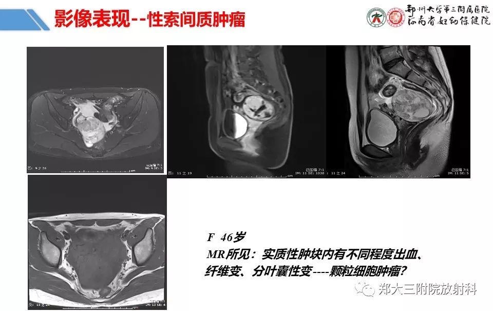 【PPT】卵巢肿瘤的影像诊断思路 【PPT】卵巢肿瘤的影像诊断思路