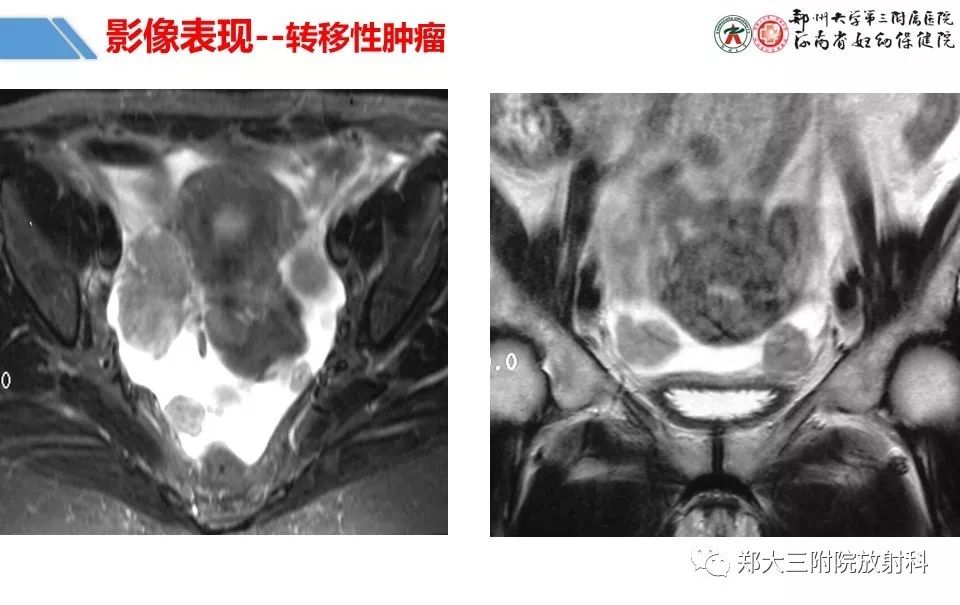 【PPT】卵巢肿瘤的影像诊断思路 【PPT】卵巢肿瘤的影像诊断思路