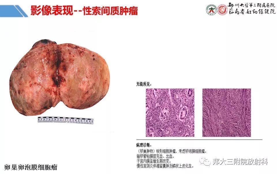 【PPT】卵巢肿瘤的影像诊断思路 【PPT】卵巢肿瘤的影像诊断思路