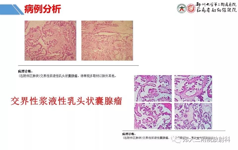 【PPT】卵巢肿瘤的影像诊断思路 【PPT】卵巢肿瘤的影像诊断思路