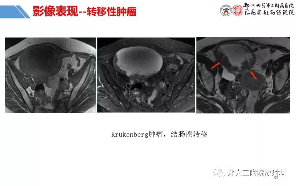 【PPT】卵巢肿瘤的影像诊断思路 【PPT】卵巢肿瘤的影像诊断思路