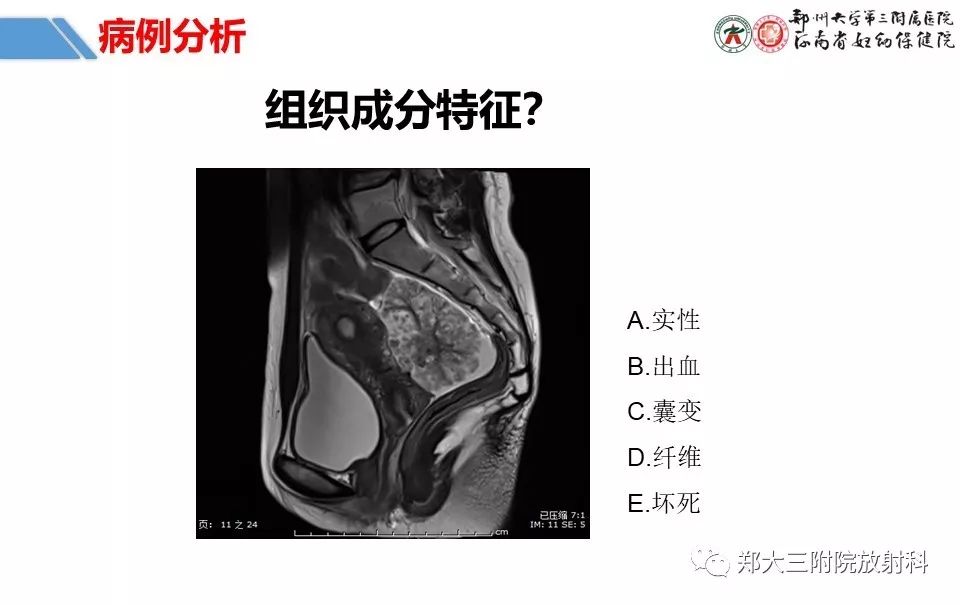 【PPT】卵巢肿瘤的影像诊断思路 【PPT】卵巢肿瘤的影像诊断思路