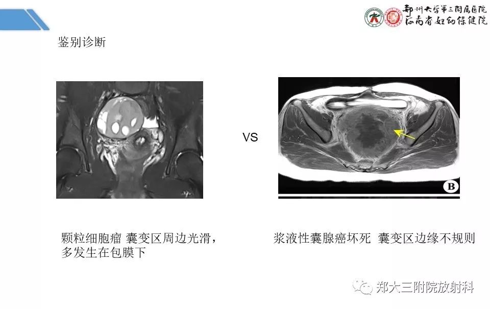 【PPT】卵巢肿瘤的影像诊断思路 【PPT】卵巢肿瘤的影像诊断思路