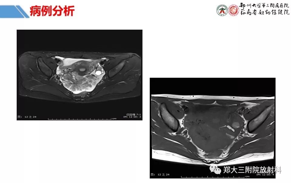 【PPT】卵巢肿瘤的影像诊断思路 【PPT】卵巢肿瘤的影像诊断思路