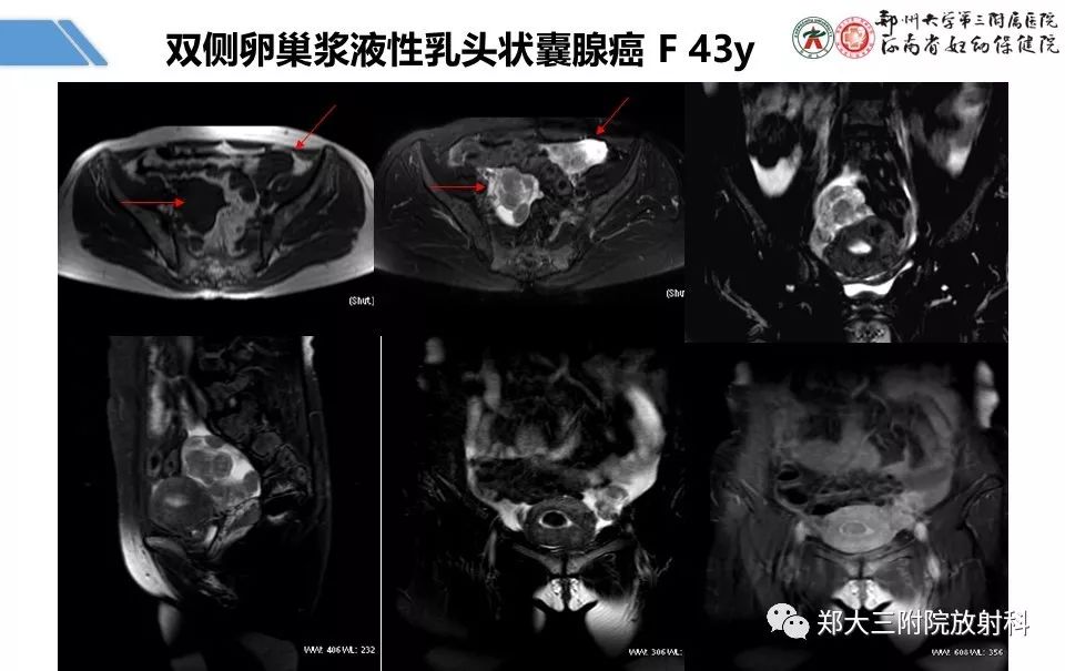 【PPT】卵巢肿瘤的影像诊断思路 【PPT】卵巢肿瘤的影像诊断思路