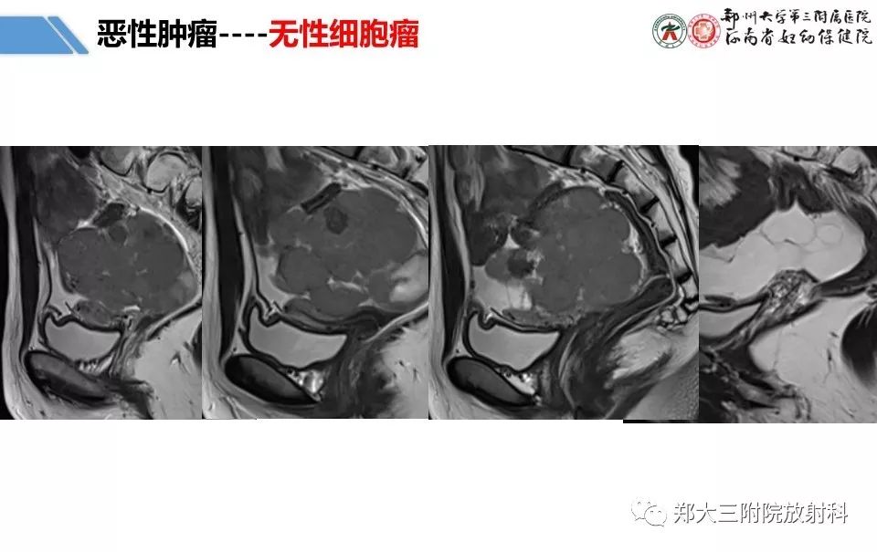 【PPT】卵巢肿瘤的影像诊断思路 【PPT】卵巢肿瘤的影像诊断思路