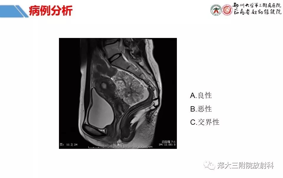 【PPT】卵巢肿瘤的影像诊断思路 【PPT】卵巢肿瘤的影像诊断思路
