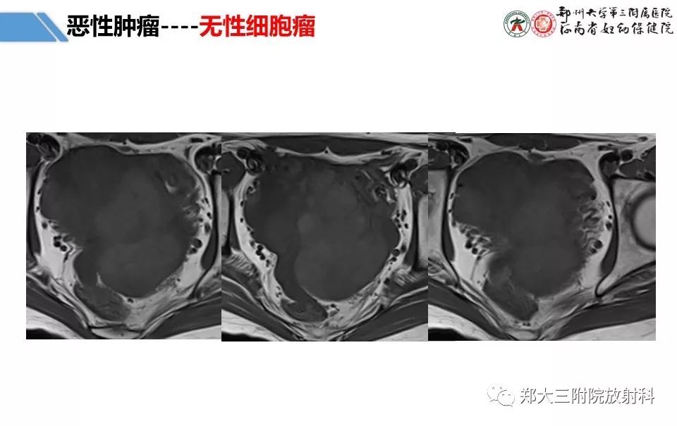 【PPT】卵巢肿瘤的影像诊断思路 【PPT】卵巢肿瘤的影像诊断思路