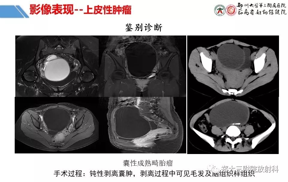【PPT】卵巢肿瘤的影像诊断思路 【PPT】卵巢肿瘤的影像诊断思路