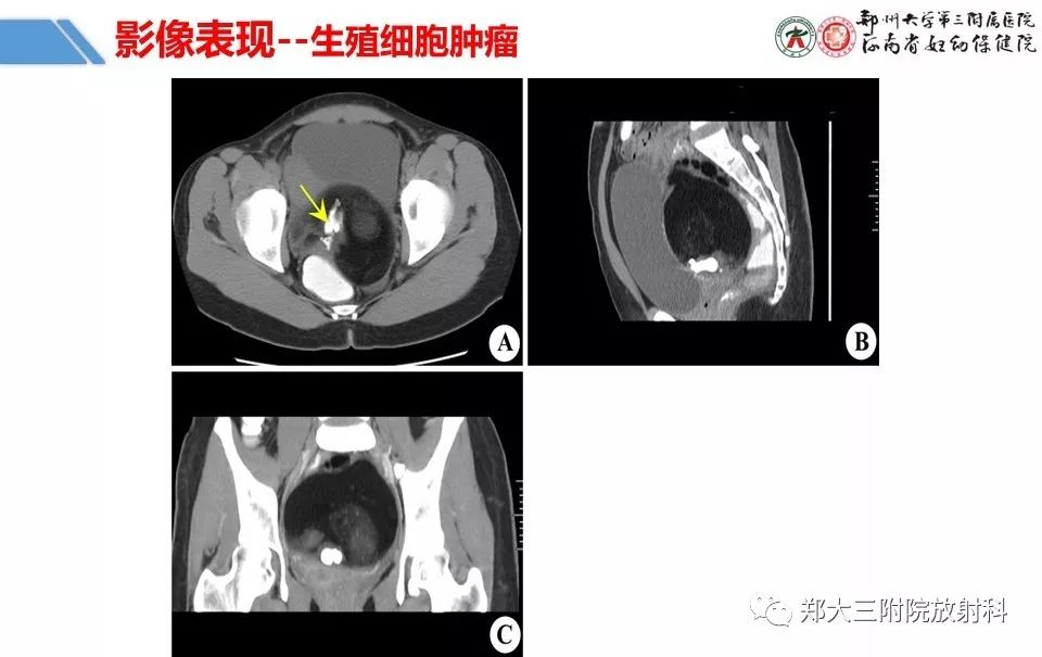 【PPT】卵巢肿瘤的影像诊断思路 【PPT】卵巢肿瘤的影像诊断思路