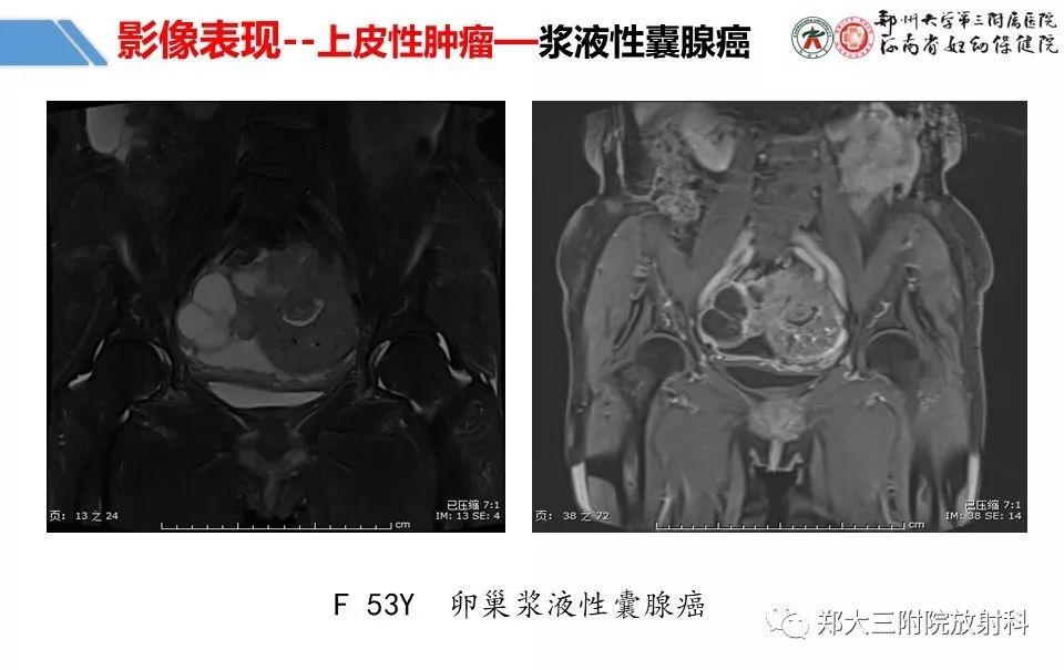 【PPT】卵巢肿瘤的影像诊断思路 【PPT】卵巢肿瘤的影像诊断思路