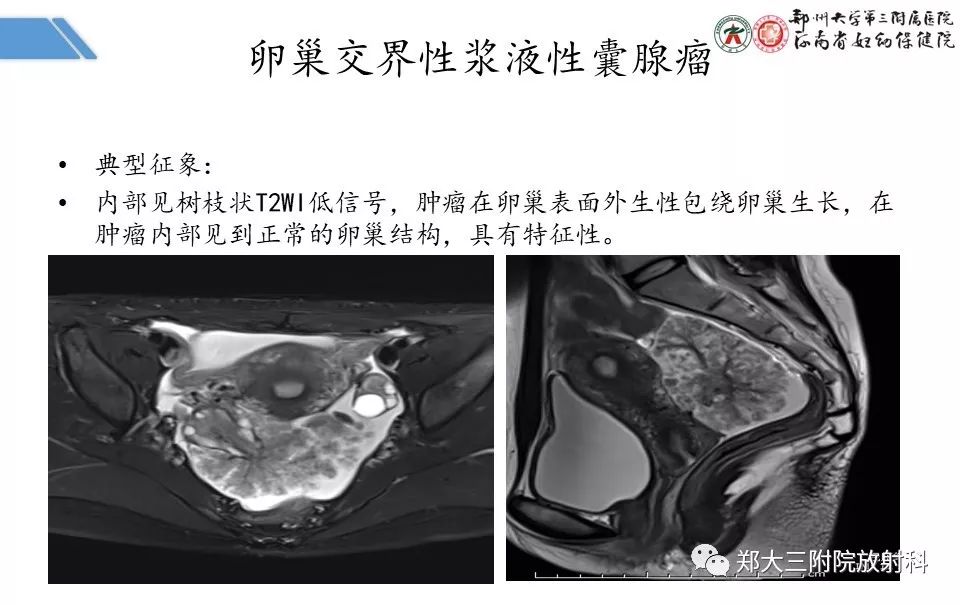 【PPT】卵巢肿瘤的影像诊断思路 【PPT】卵巢肿瘤的影像诊断思路