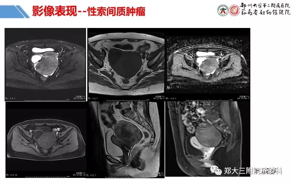【PPT】卵巢肿瘤的影像诊断思路 【PPT】卵巢肿瘤的影像诊断思路