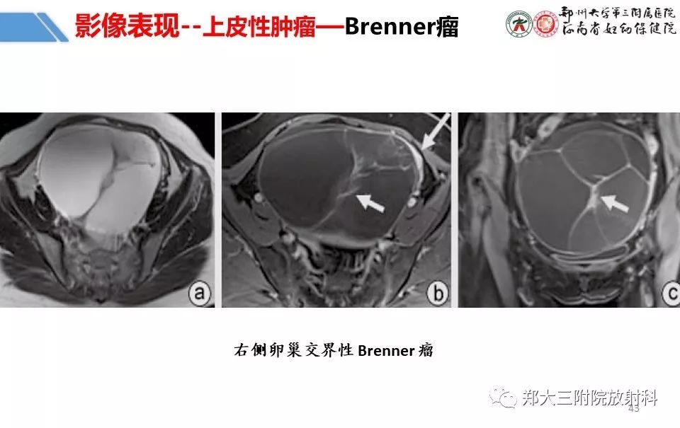 【PPT】卵巢肿瘤的影像诊断思路 【PPT】卵巢肿瘤的影像诊断思路