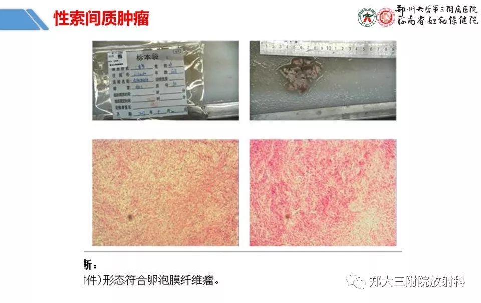 【PPT】卵巢肿瘤的影像诊断思路 【PPT】卵巢肿瘤的影像诊断思路