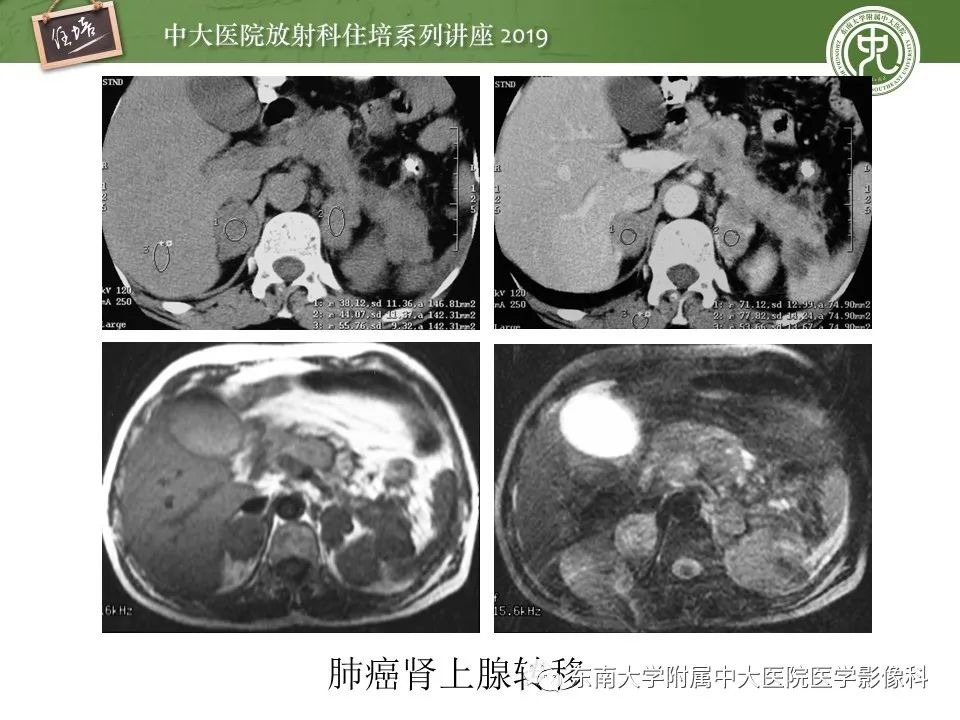 【PPT】肾上腺病变临床与影像思路分析
