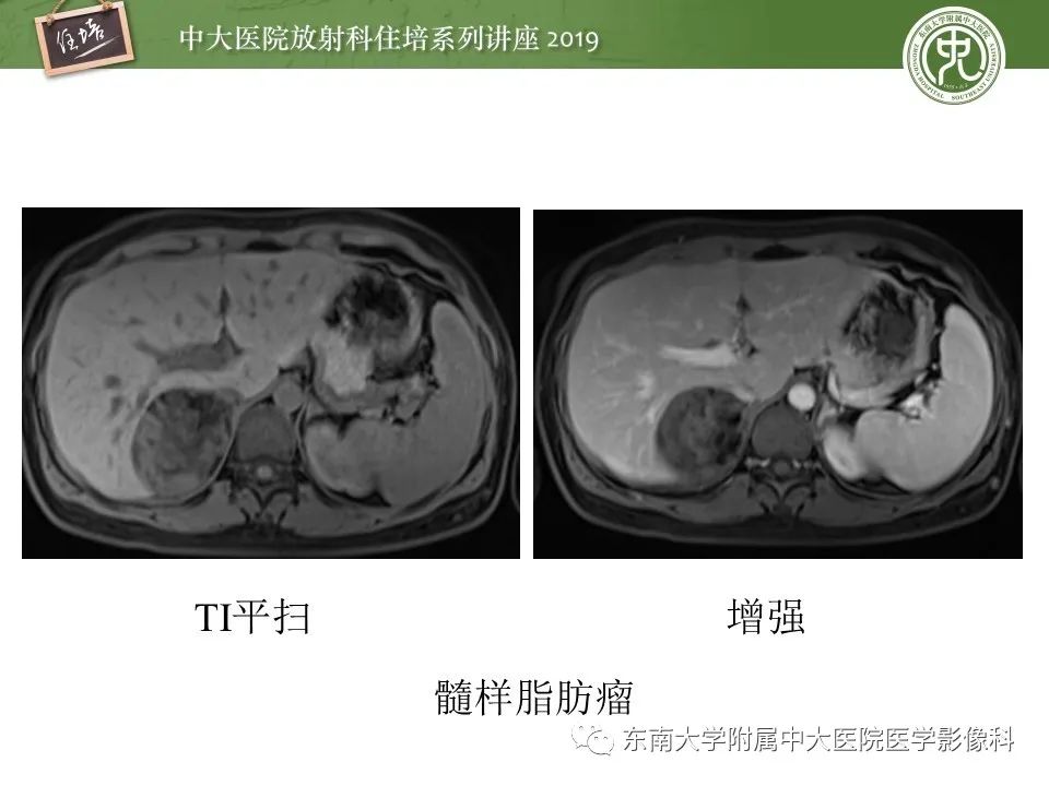 【PPT】肾上腺病变临床与影像思路分析