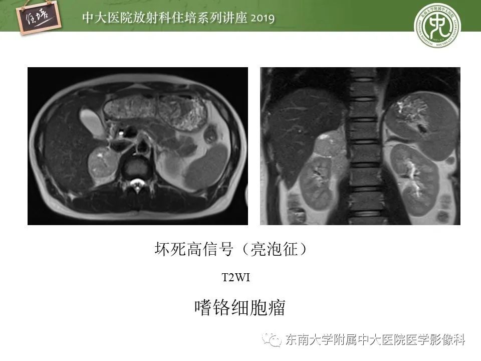 【PPT】肾上腺病变临床与影像思路分析