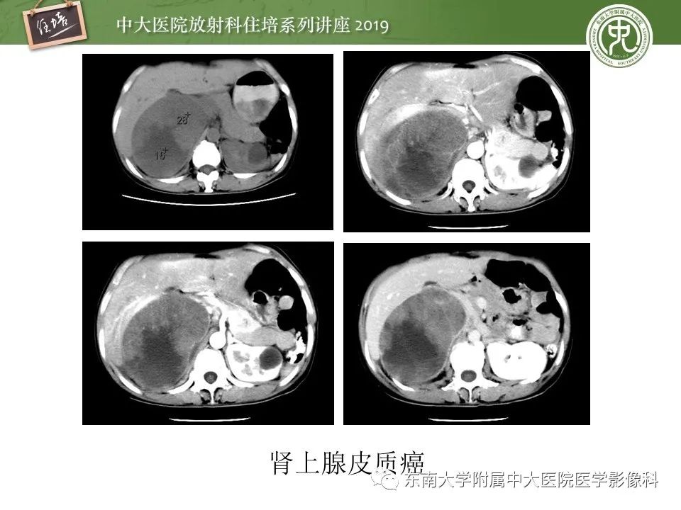 【PPT】肾上腺病变临床与影像思路分析