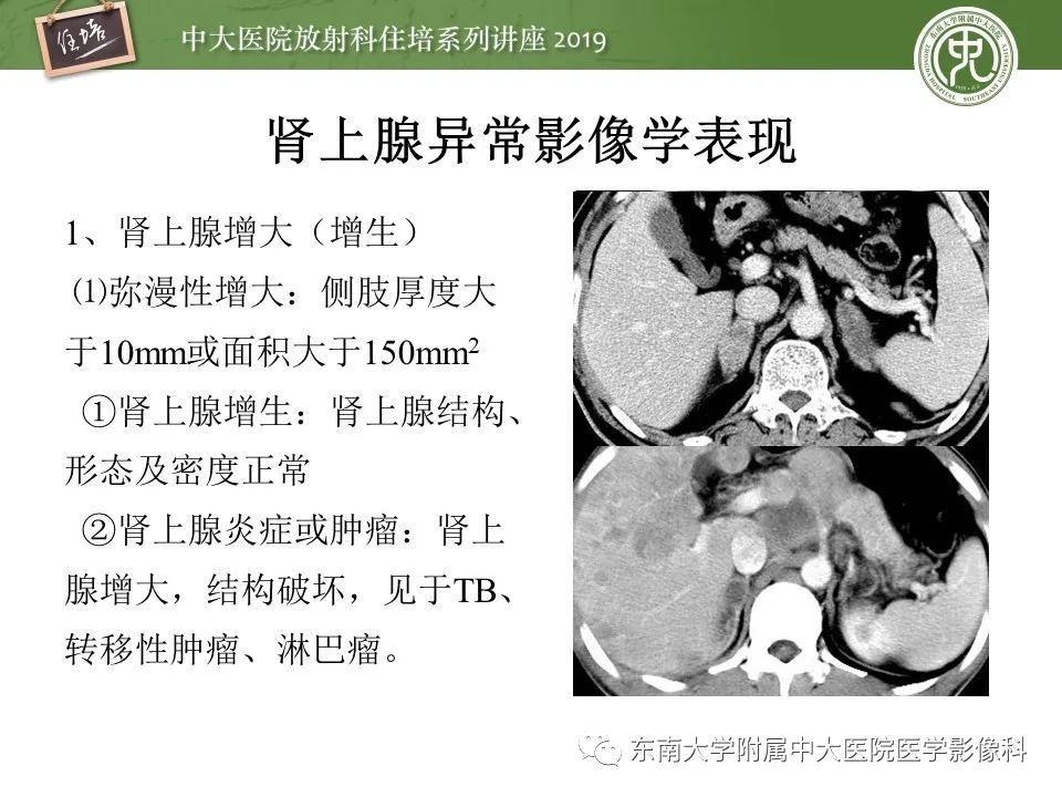 【PPT】肾上腺病变临床与影像思路分析