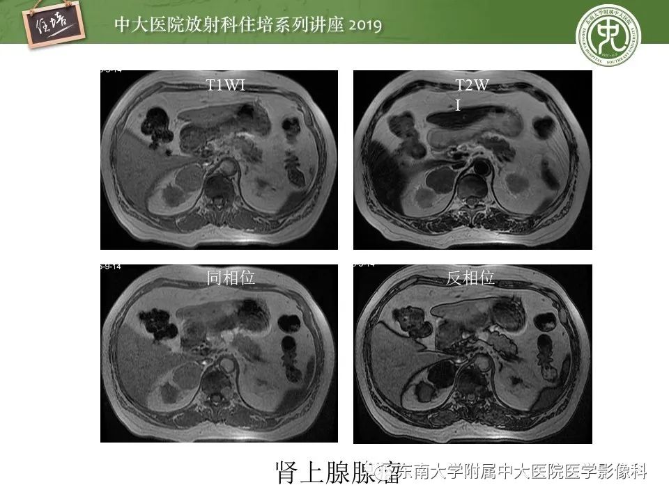【PPT】肾上腺病变临床与影像思路分析