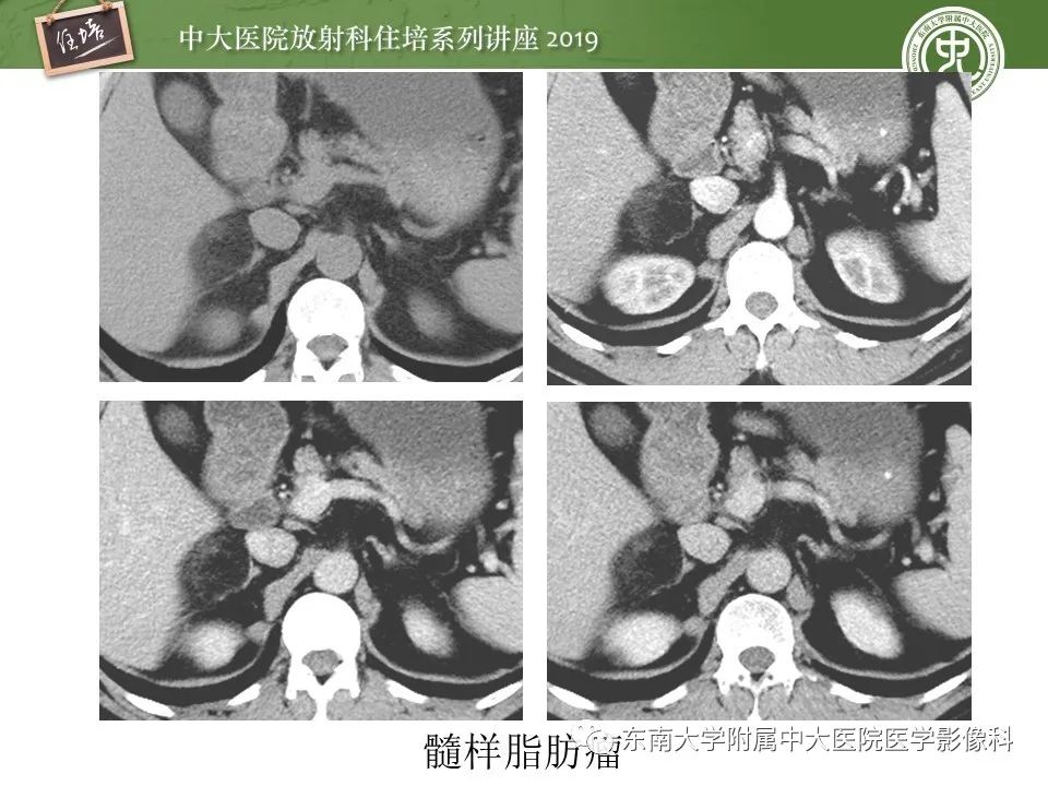 【PPT】肾上腺病变临床与影像思路分析