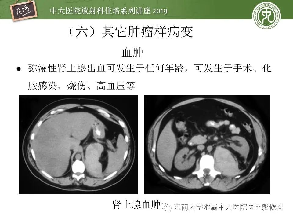 【PPT】肾上腺病变临床与影像思路分析