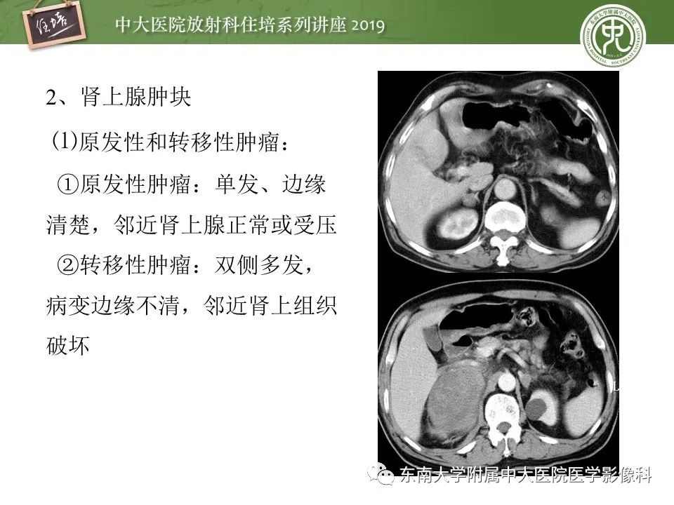 【PPT】肾上腺病变临床与影像思路分析