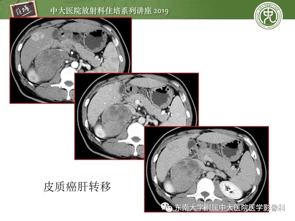 【PPT】肾上腺病变临床与影像思路分析