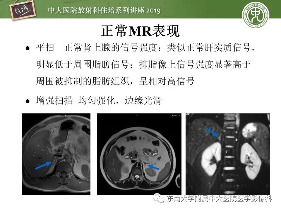 【PPT】肾上腺病变临床与影像思路分析