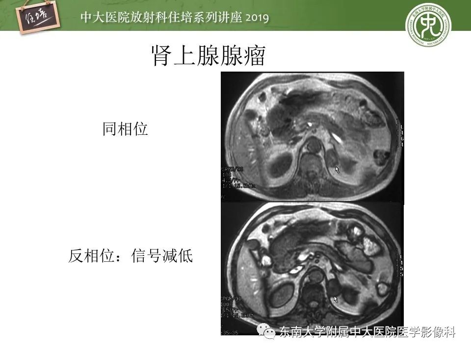 【PPT】肾上腺病变临床与影像思路分析