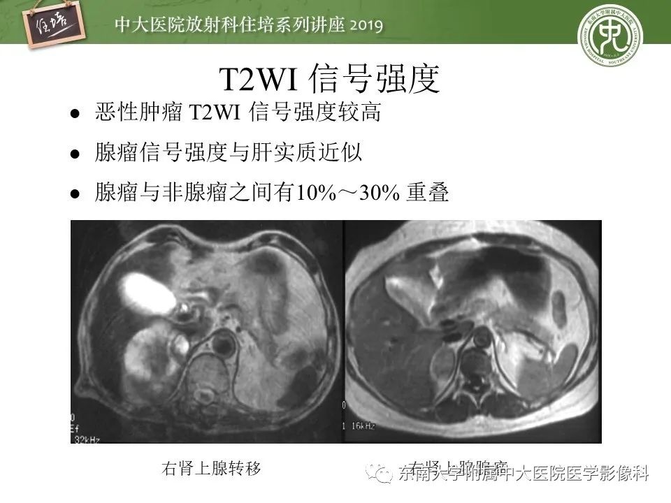 【PPT】肾上腺病变临床与影像思路分析