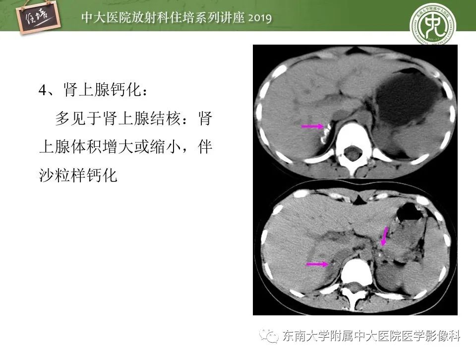【PPT】肾上腺病变临床与影像思路分析
