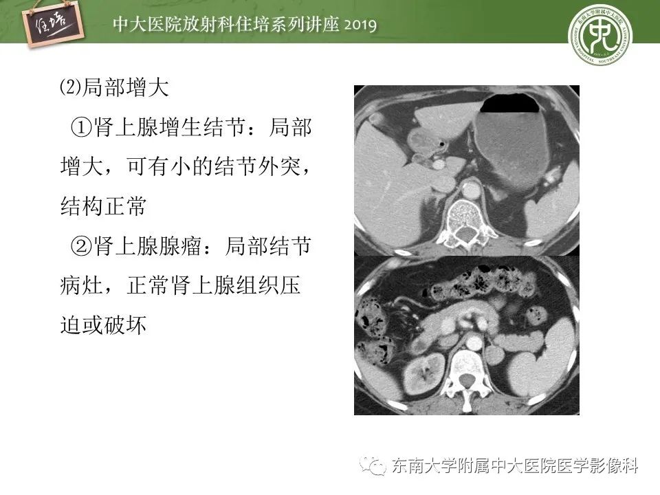 【PPT】肾上腺病变临床与影像思路分析