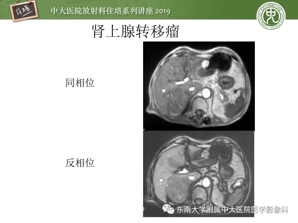 【PPT】肾上腺病变临床与影像思路分析