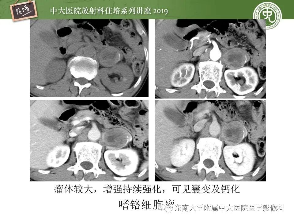 【PPT】肾上腺病变临床与影像思路分析