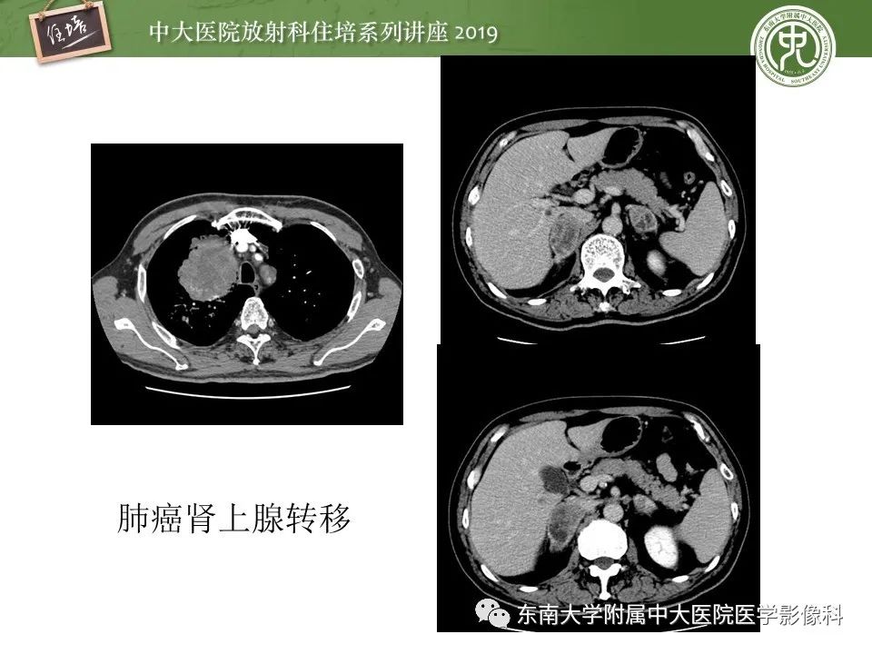 【PPT】肾上腺病变临床与影像思路分析