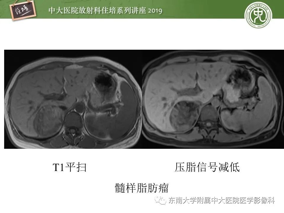 【PPT】肾上腺病变临床与影像思路分析